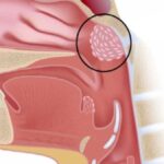 Adenoidid Removal Surgery: What to Expect Before, During, and After